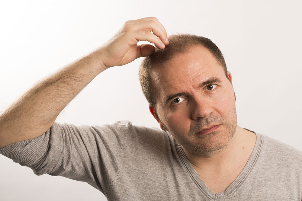 5 Natural Remedies to Manage Male Pattern Baldness